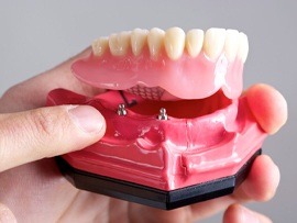 An image of implant-supported dentures