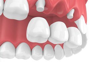 Illustration of zirconia dental implants in gums without crowns