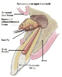 Root End Surgery San Antonio Oral Maxillofacial Surgery Associates P A San Antonio Castroville Tx