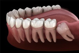 impacted wisdom tooth