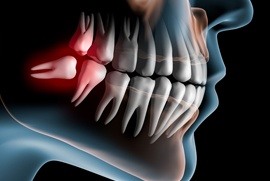 impacted wisdom tooth