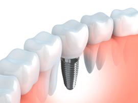An image of a dental implant